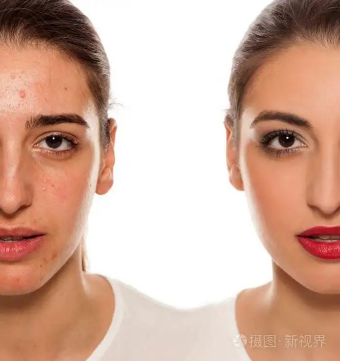 美容|女性面部皮肤状态与中医体质类型真是大测评