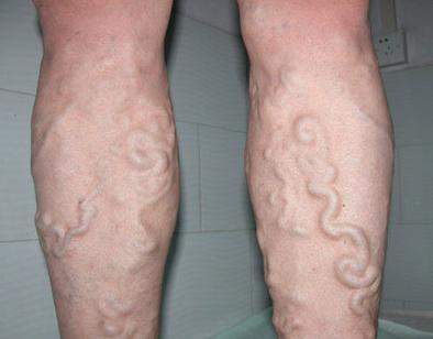 静脉曲张|斩不断，理还乱？恼人的下肢静脉曲张，手术后为何总复发？