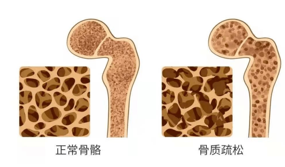 骨质疏松|65岁大爷练就一身铜筋铁骨,医生:他的养骨经验很赞,5 个小妙招快学习