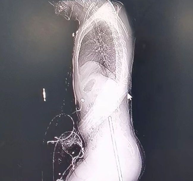 福州男子高空坠落半米钢筋插入下体!