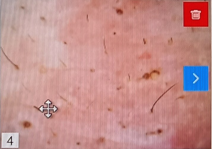 医院|“缠腰蛇”带状疱疹痛如刀割,怎么治好得快?3个方法可快速治疗