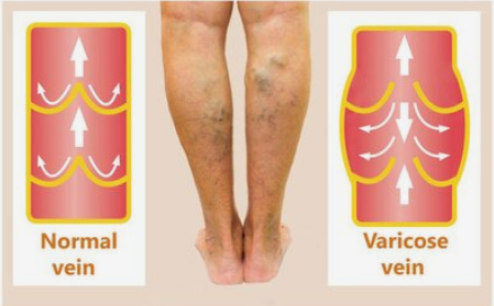 静脉曲张|静脉曲张不可怕!“直击灵魂”三大问:找对人、管住嘴、迈开腿?