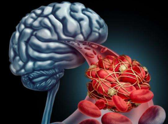 韭菜|脑梗多是吃出来的!内科专家忠告:身体2处“发硬”,多半是脑梗“前兆”