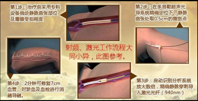 静脉曲张|深度分析-----如何选择最“好”的静脉曲张手术?