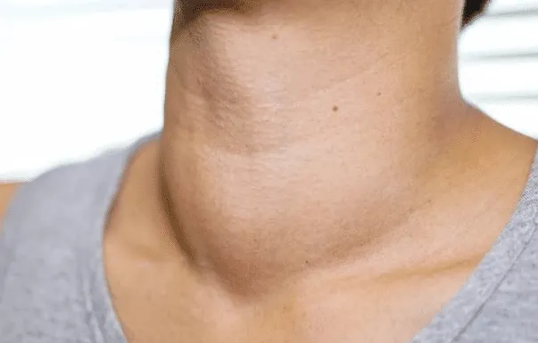 慢性腹泻|《柳叶刀》点名批评:“敷衍式”早餐,天天当成宝,甲状腺不烂才怪