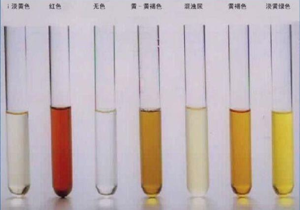 尿酸|47岁男子尿酸高达810,肾衰离世,医生:常喝1水,等于“自残”