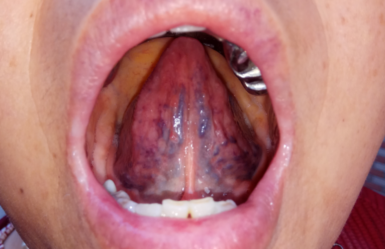 人均寿命|辨舌象,察病情,从四种舌象中找到“治癌”方法!