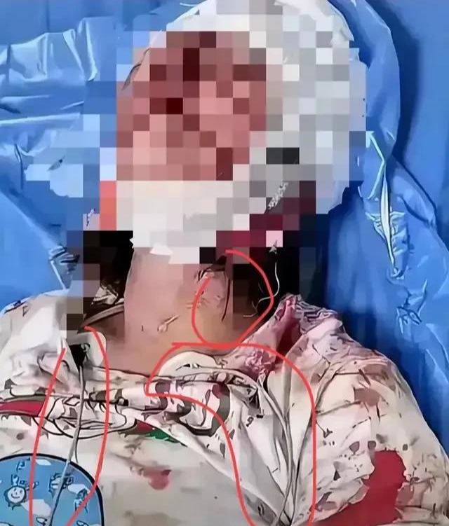 烧烤店被围殴女孩有新消息?受伤女孩母亲首次发声!网友提出质疑
