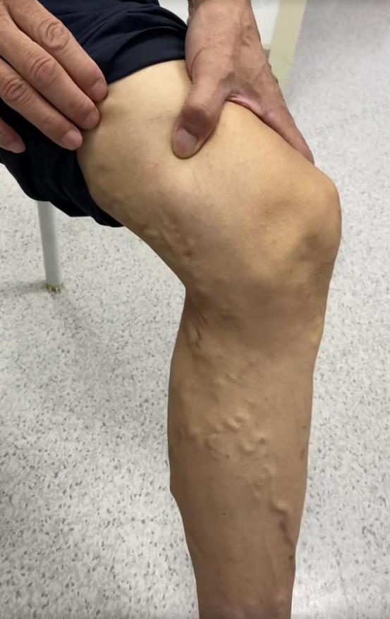 静脉曲张|蚯蚓腿小腿爆青筋是为何？六旬培训师小腿爆青筋，直呼跳舞难看想“换腿”！