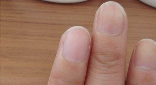 高血糖|手指甲一截红一截白？是不是林赛氏指甲？那可是慢性肾病的征兆
