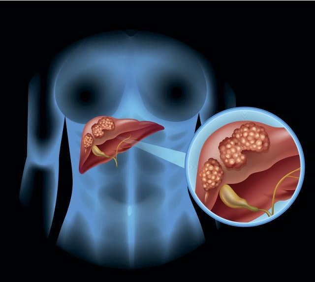 高血压|肝癌虽然可怕，但掌握了4个好方法，它就进不了你的门