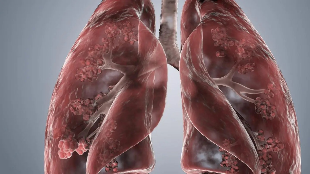 甲状腺|清理肺部的食物，不是猪血，而是它，平时多吃点，清肺更养肺！