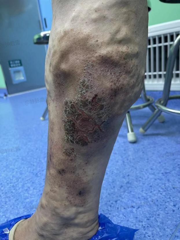 |10年前治疗的曲张静脉“卷土重来”,变本加厉,小腿变黑溃疡