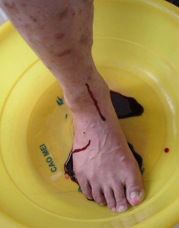 静脉曲张|【门诊纪实】中药泡脚、中医放血可以治愈下肢静脉曲张吗？