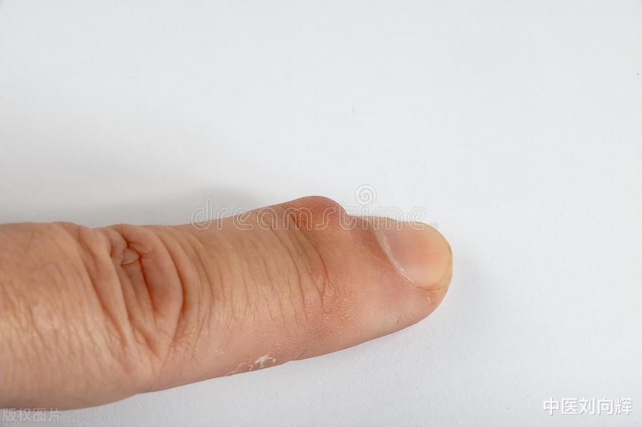 甲状腺癌|结节、囊肿、息肉？一剂小金丹，一路破结，一路化痰，一路通络