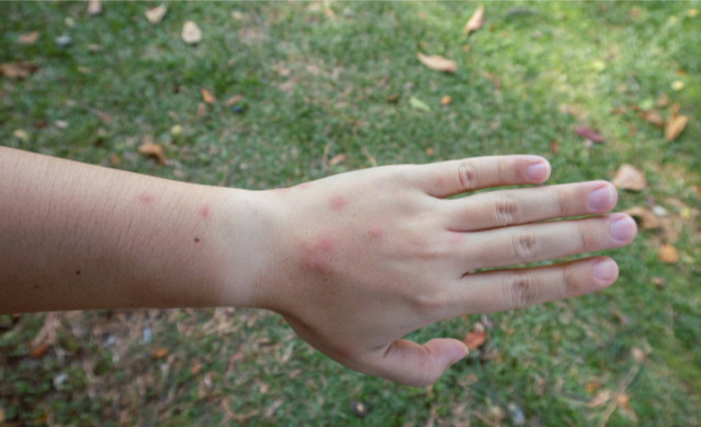 肝脏|荨麻疹患者,该如何饮食?为你列出“宜忌”食物清单,不妨照着吃