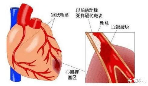 心肌梗塞|40岁男子平时“体健”，心脏血管为啥突然堵塞？