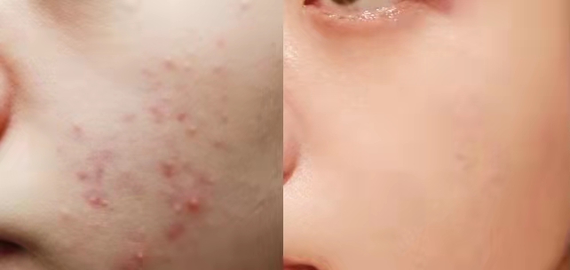 黑头 纯干货！！油痘肌必看！亲测实用祛痘、祛痘印、去黑头指南