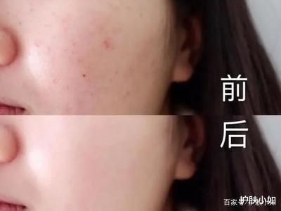 睡眠|一篇文章教你辨认闭口，解决闭口