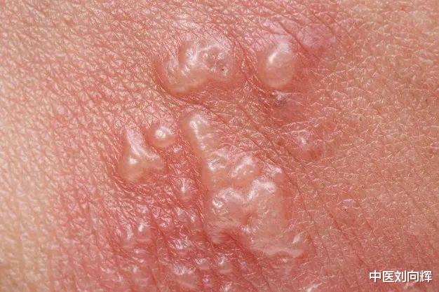 带状疱疹|带状疱疹神经痛?吃止痛药不治本?中医教你怎么治