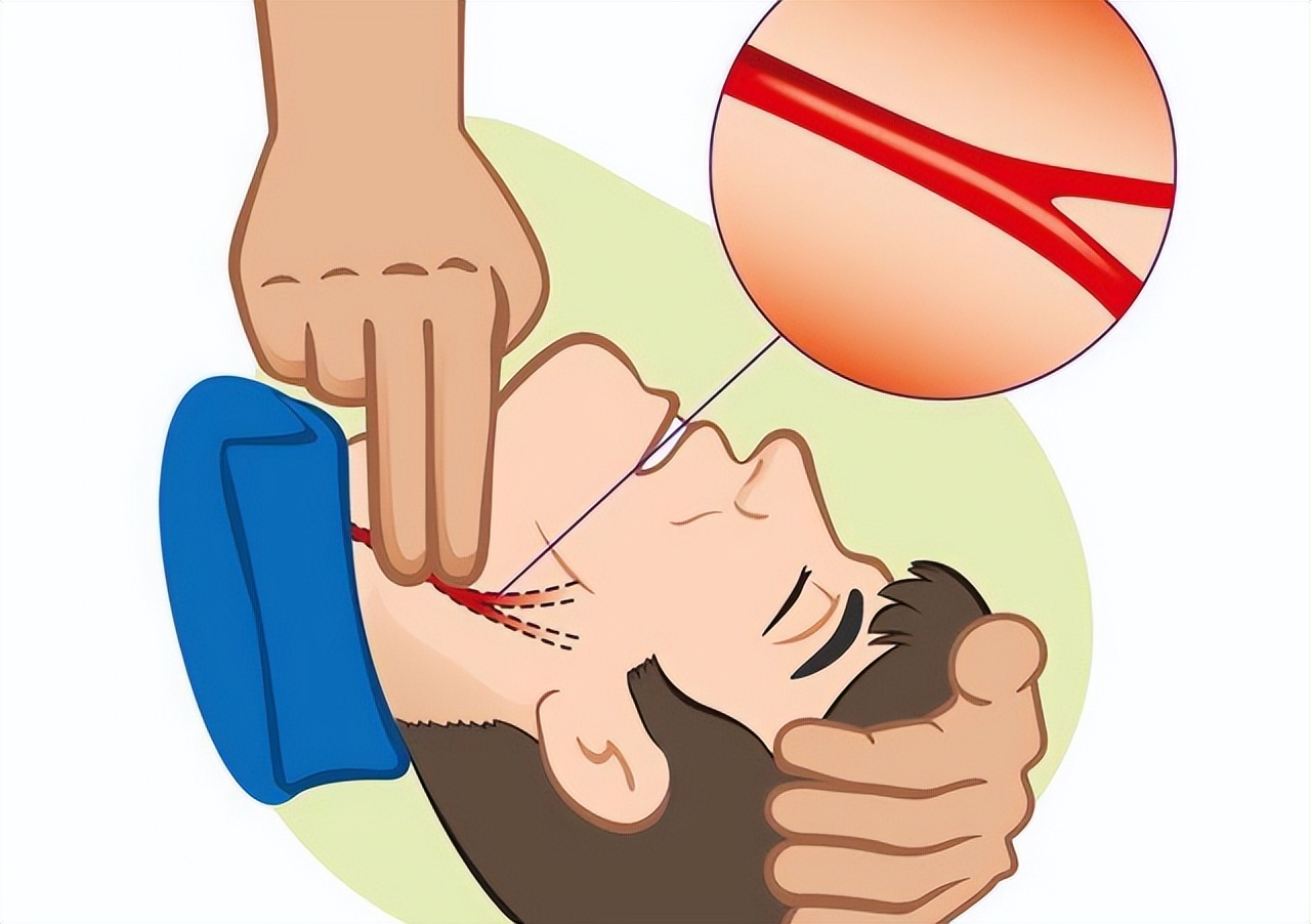 医生|什么样的人长了颈动脉斑块不用管?医生:看看7种情况你有没有