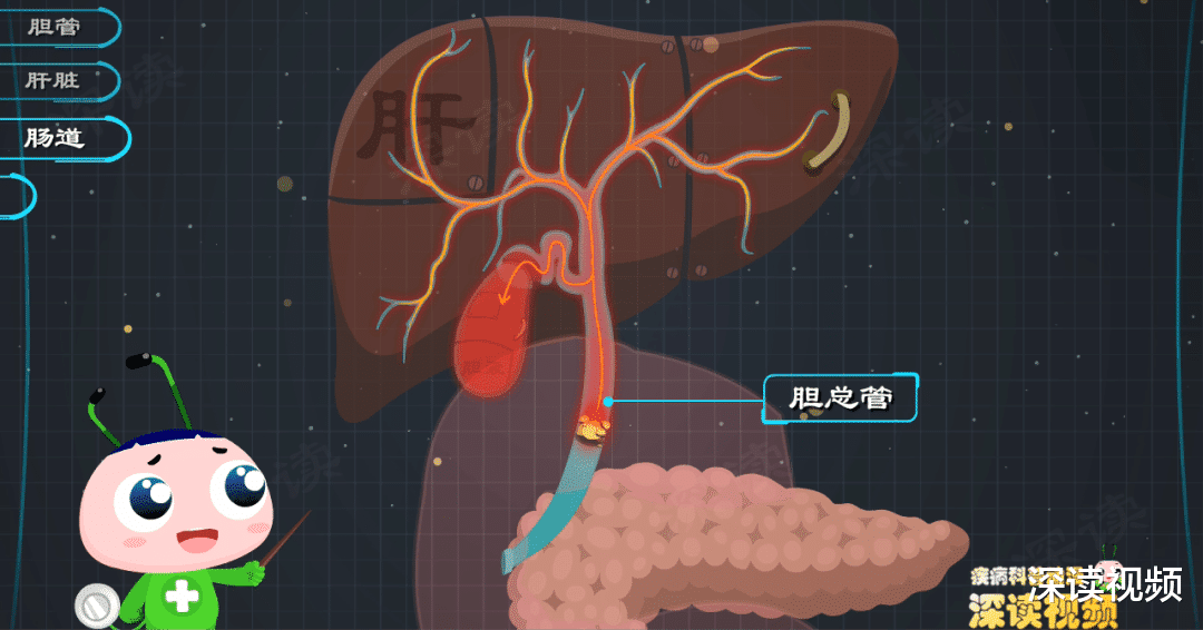 胆管结石|胆管结石是怎么搞坏你的肝，胆，肠，胰的？画得太棒了！
