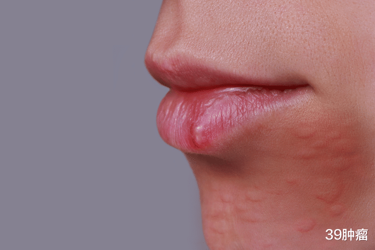 口腔溃疡|体内有癌，嘴知道？提醒：口腔出现5种现象，可能是癌在打招呼