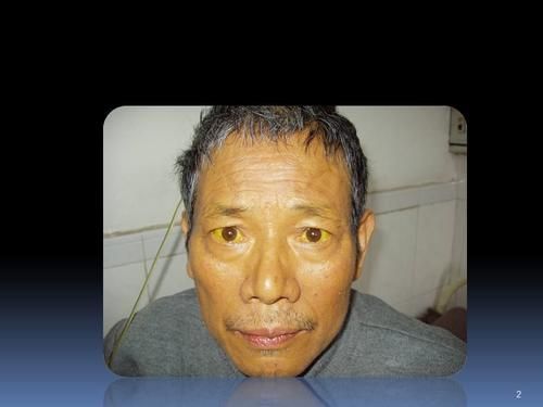 瓜子|瓜子，究竟是伤肝还是养肝？医生提醒：这2种“瓜子”，还需少吃