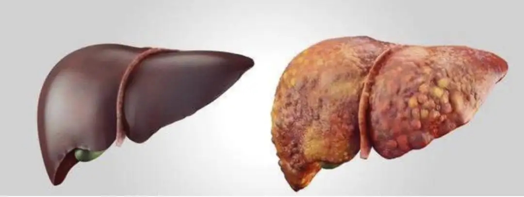 肝硬化|得了肝硬化,还能活多久?