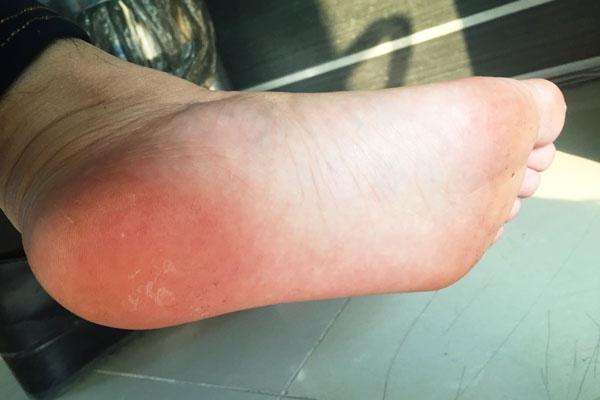 穴位|脚上若出现这3个不起眼的症状,可能是大病要来的征兆,别忽视!