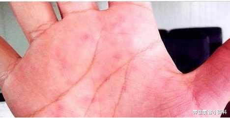 高血压|想知道肝脏好不好？ 伸出“手”来看一看， 别不当回事