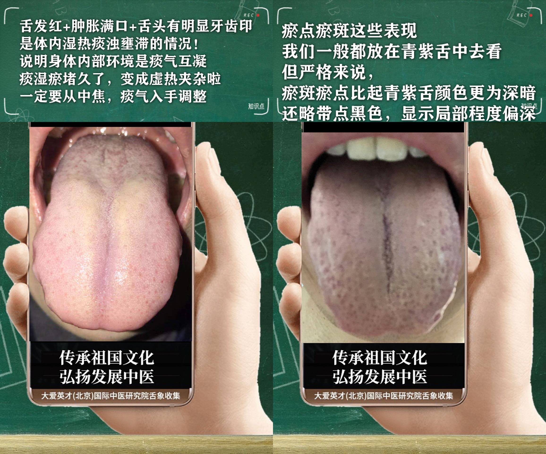 脾胃|中医实例:反复胃痛,爱打喷嚏,多汗且粘,脾胃不和