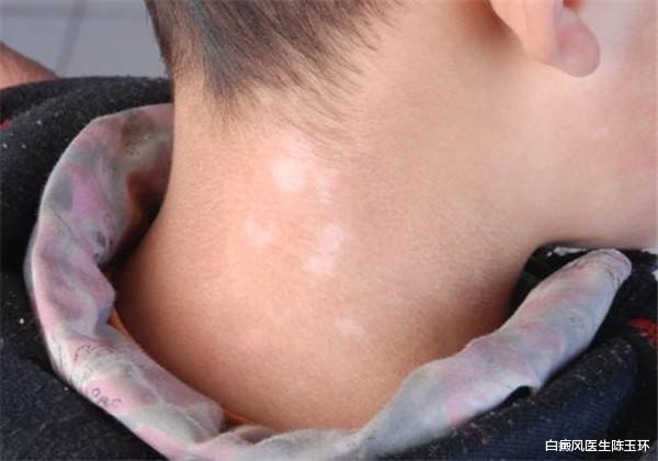 辣椒|抵抗新冠，对抗白癜风，都少不了身体免疫力！