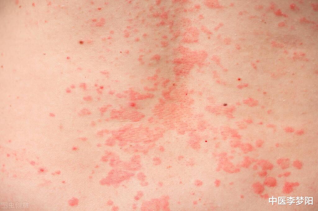 痛风|中成药如意金黄散,既能清热解毒,还可用于这5种情况,你知道?