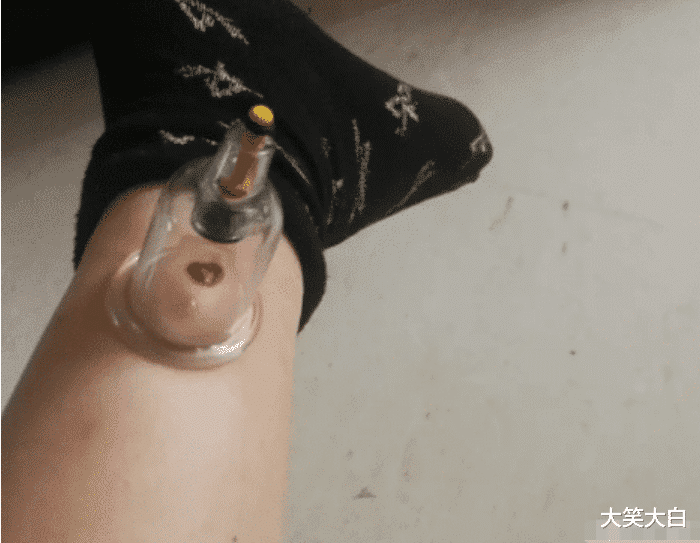 相宜本草 “被蜜蜂蛰了，奶奶说拔罐逼出毒血就好了”，但为啥却越长越大