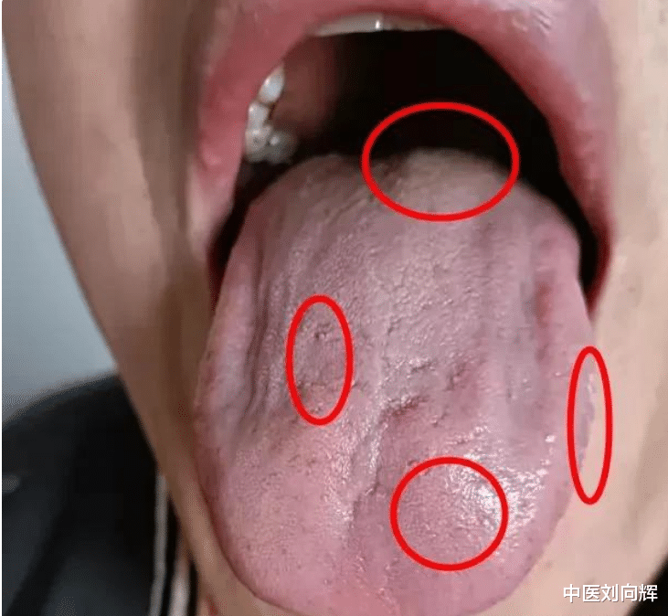 胃病|哪种舌像容易长息肉,结节,囊肿?刘医生教你如何用一味中药攻破