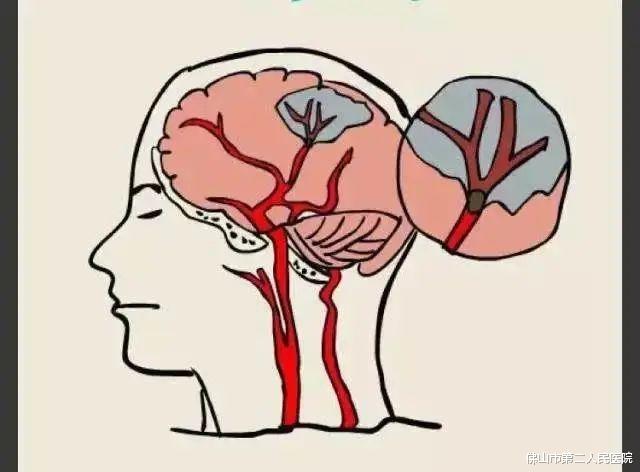 脑卒中|脑卒中偏瘫，这些护理要点不可忽视！