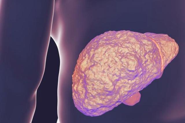 养生|肝科医生:肝硬化早期时,身体会出现这5个“迹象”,别忽视!