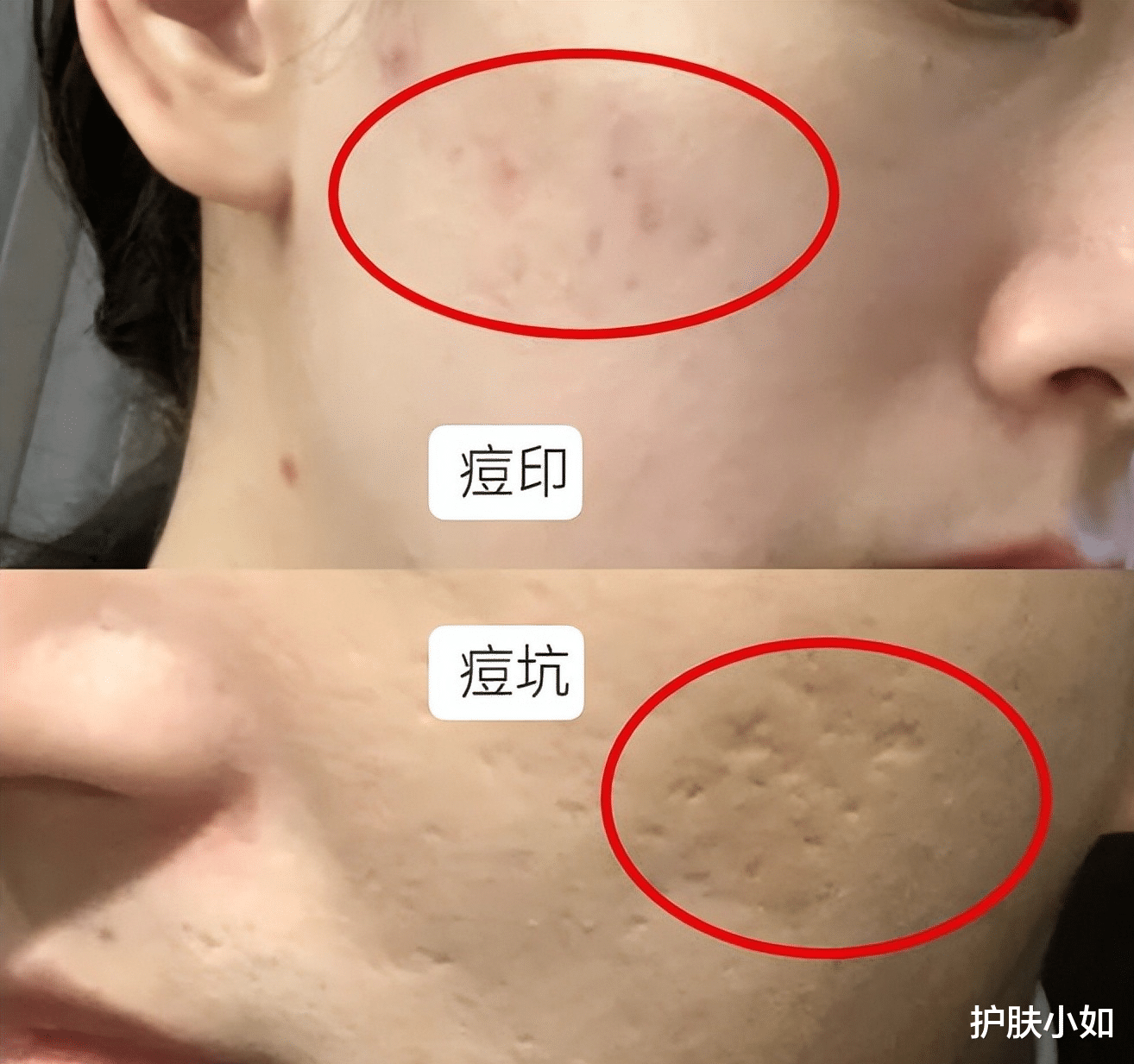 西瓜 十问十答，夏季脸上长痘常见问题解答，避坑指南