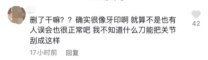 小贝|知名吃播小贝饿了又被指催吐，手指关节伤口似牙印，大批粉丝质疑
