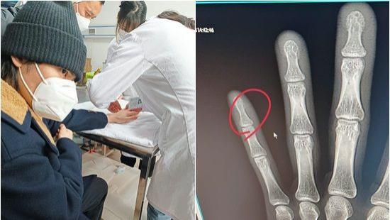 萧敬腾|萧敬腾传“骨头整根裂开移位”急送医！一照X光GG了，伤照曝光