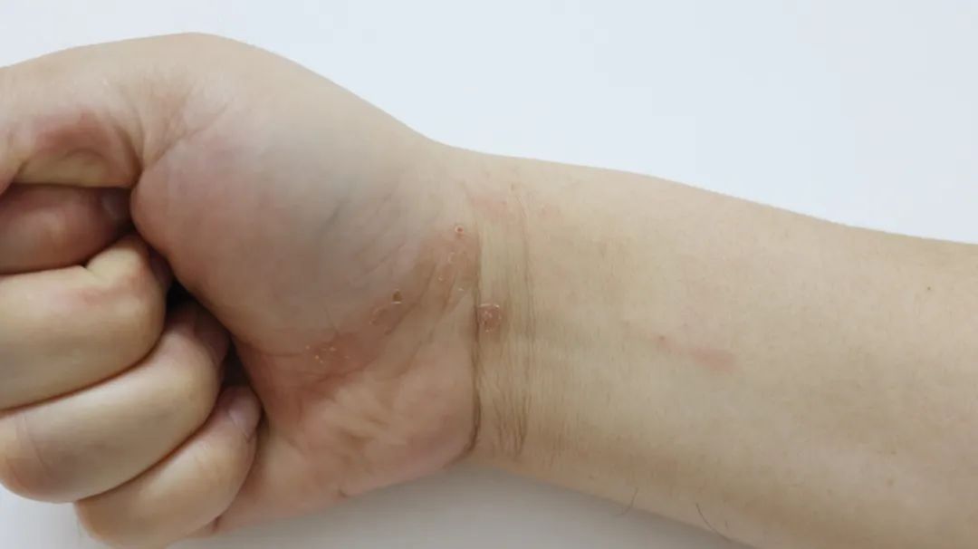 牙齿|皮肤瘙痒剧烈，起小水疱，这可能是湿疹！掌握这些方法，远离湿疹