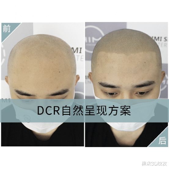 高血压|秃了,去纹发,这些建议一定要先看!