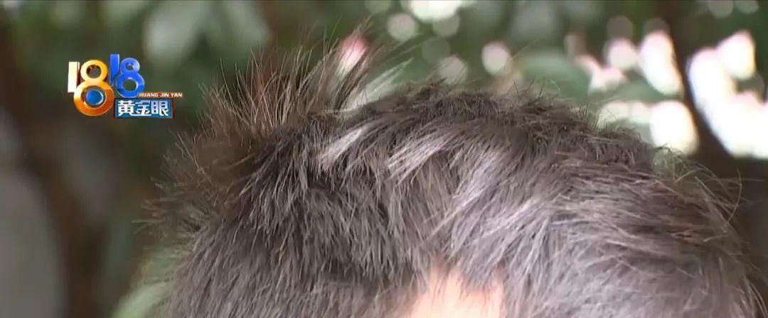 鸡蛋 脱发还有扁平疣 “没办法”付了一万多？