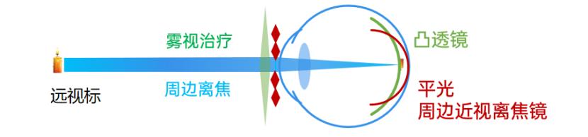 近视|第四讲(5)中心成像超前--雾视治疗概述