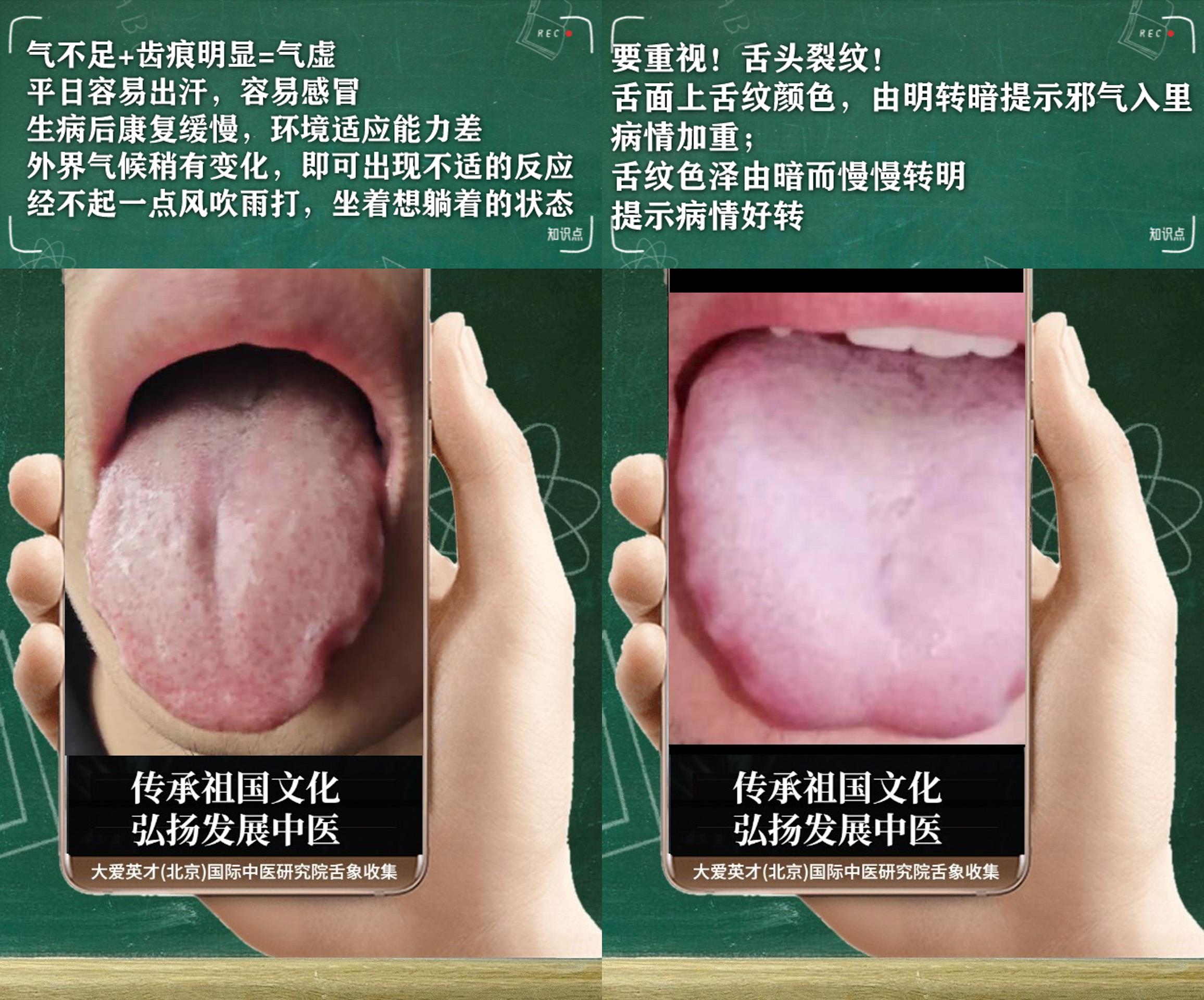 咳嗽|中医解析：常爆躁，爱做噩梦，寒痰互凝，容易发作很烦躁