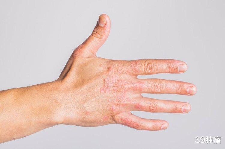 肺癌|出现“杵状指”,是肺癌的信号吗?有这种可能,但没那么简单