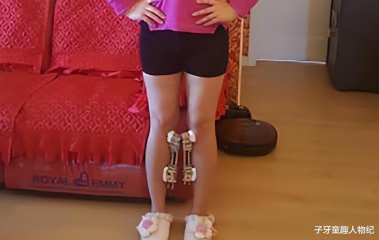 整容|红粉宝宝：16岁开始整容，花400万整容200多次，最后沦落到坐轮椅