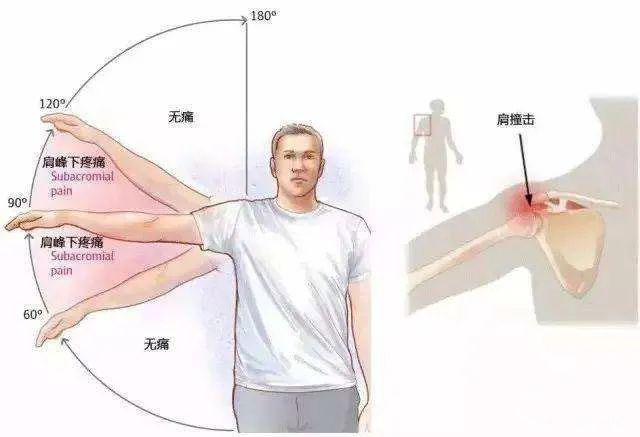 口腔溃疡|直乐医院大讲堂：肩膀酸痛是怎么回事? 教你预防颈肩痛小妙招