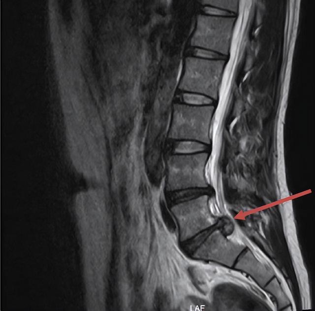 肠胃|男子为八块腹肌突击健身，结果腰“突”了！这样的“隐患”不少人都有